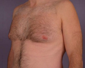 Breast Reduction (for Men)