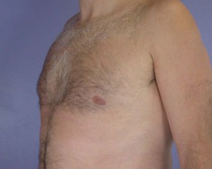 Breast Reduction (for Men)