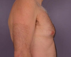 Breast Reduction (for Men)