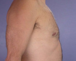 Breast Reduction (for Men)