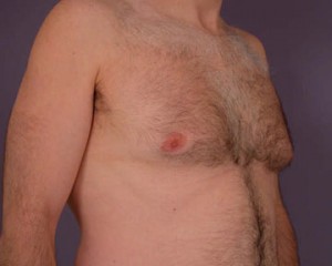 Breast Reduction (for Men)