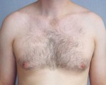 Breast Reduction (for Men)