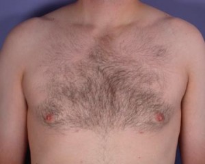 Breast Reduction (for Men)