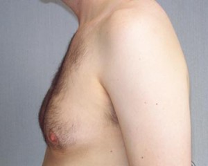 Breast Reduction (for Men)