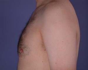 Breast Reduction (for Men)