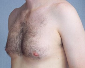 Breast Reduction (for Men)