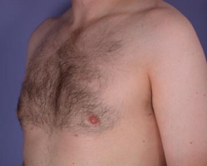 Breast Reduction (for Men)