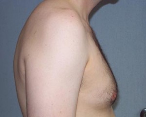 Breast Reduction (for Men)