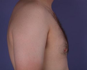 Breast Reduction (for Men)