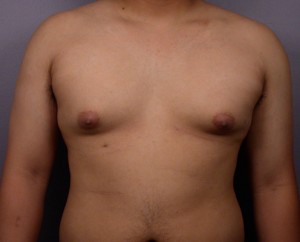 Breast Reduction (for Men)