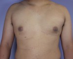 Breast Reduction (for Men)