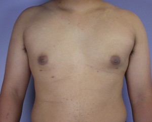 Breast Reduction (for Men)