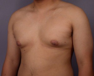 Breast Reduction (for Men)