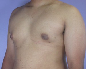 Breast Reduction (for Men)