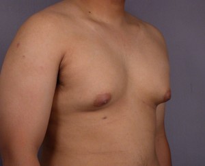 Breast Reduction (for Men)