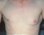 Breast Reduction (for Men)