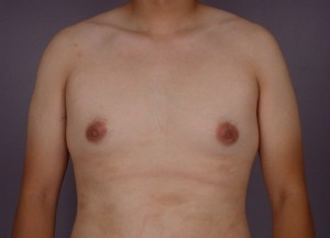 Breast Reduction (for Men)