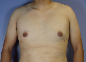 Breast Reduction (for Men)