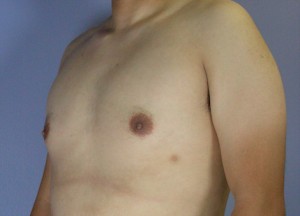 Breast Reduction (for Men)