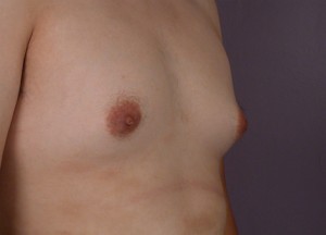 Breast Reduction (for Men)