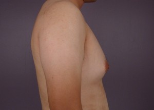 Breast Reduction (for Men)