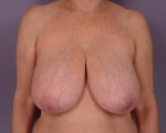 Breast Reduction (for Women)