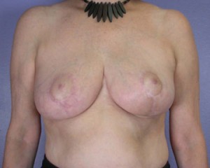 Breast Reduction (for Women)