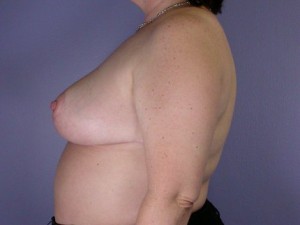 Breast Reduction (for Women)