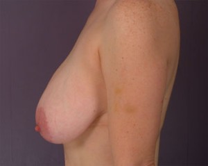 Breast Reduction (for Women)