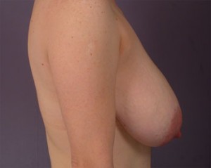 Breast Reduction (for Women)