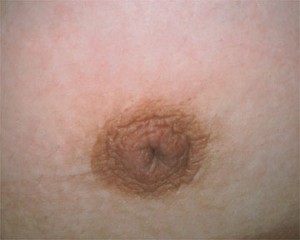 Nipple - Inversion Correction