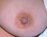 Nipple - Inversion Correction