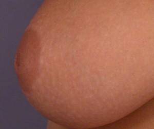 Nipple - Inversion Correction