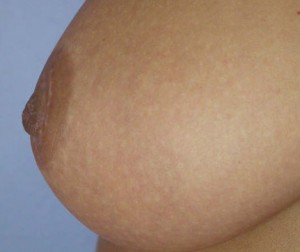 Nipple - Inversion Correction