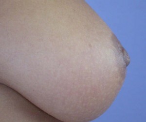 Nipple - Inversion Correction