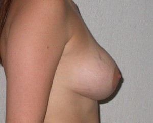 Breast Asymmetry Correction