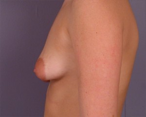 Breast Asymmetry Correction