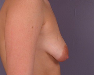 Breast Asymmetry Correction