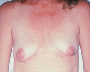 Breast Asymmetry Correction