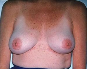 Breast Asymmetry Correction