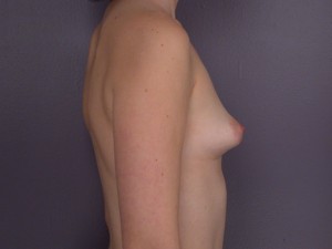 Breast Asymmetry Correction