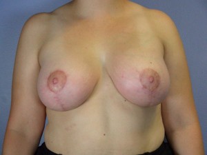 Breast Asymmetry Correction