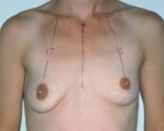 Breast Asymmetry Correction