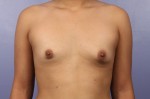 Breast Asymmetry Correction