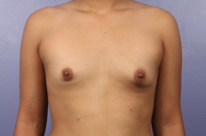 Breast Asymmetry Correction