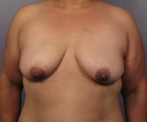 Breast Lift