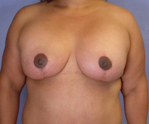 Breast Lift