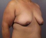 Breast Lift