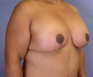 Breast Lift