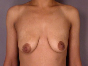 Breast Lift with Augmentation